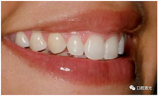 利用口腔激光增強瓷貼面最終美學(xué)效果 利用口腔激光增強瓷貼面最終美學(xué)效果