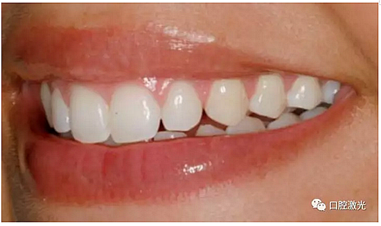 利用口腔激光增強瓷貼面最終美學(xué)效果 利用口腔激光增強瓷貼面最終美學(xué)效果