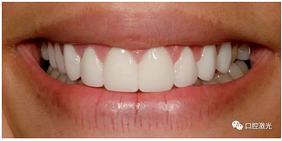 利用口腔激光增強瓷貼面最終美學(xué)效果 利用口腔激光增強瓷貼面最終美學(xué)效果