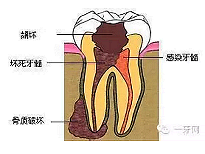 詳解牙疼的原因分幾種？