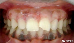 為什么我的牙齦會發(fā)黑？該如何治療？