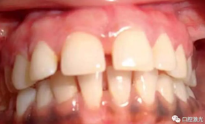 為什么我的牙齦會發(fā)黑？該如何治療？