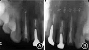 【病例討論】根管治療失敗患牙再治療一例(上) 【病例討論】根管治療失敗患牙再治療一例(上)