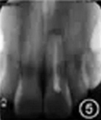 【病例討論】根管治療失敗患牙再治療一例(上) 【病例討論】根管治療失敗患牙再治療一例(上)