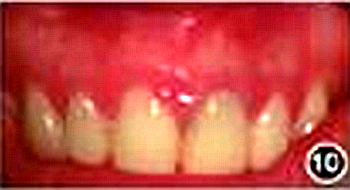 【病例討論】根管治療失敗患牙再治療一例(下) 【病例討論】根管治療失敗患牙再治療一例(下)