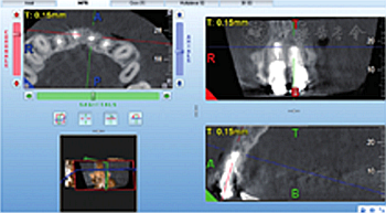 【病例討論】根管治療失敗患牙再治療一例(下) 【病例討論】根管治療失敗患牙再治療一例(下)