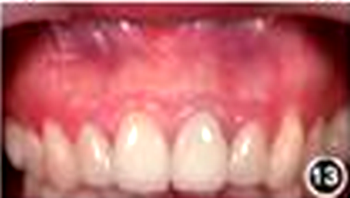 【病例討論】根管治療失敗患牙再治療一例(下) 【病例討論】根管治療失敗患牙再治療一例(下)