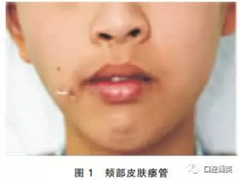 面頰部皮樣囊腫伴皮瘺1例報道 面頰部皮樣囊腫伴皮瘺1例報道