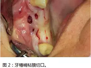 上頜竇瘺修補術(shù)——改良式旋轉(zhuǎn)帶蒂粘膜瓣修補術(shù)的應(yīng)用 上頜竇瘺修補術(shù)——改良式旋轉(zhuǎn)帶蒂粘膜瓣修補術(shù)的應(yīng)用