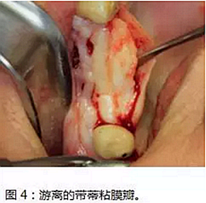 上頜竇瘺修補術(shù)——改良式旋轉(zhuǎn)帶蒂粘膜瓣修補術(shù)的應(yīng)用 上頜竇瘺修補術(shù)——改良式旋轉(zhuǎn)帶蒂粘膜瓣修補術(shù)的應(yīng)用