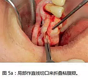 上頜竇瘺修補術(shù)——改良式旋轉(zhuǎn)帶蒂粘膜瓣修補術(shù)的應(yīng)用 上頜竇瘺修補術(shù)——改良式旋轉(zhuǎn)帶蒂粘膜瓣修補術(shù)的應(yīng)用