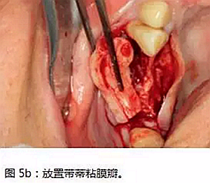 上頜竇瘺修補術(shù)——改良式旋轉(zhuǎn)帶蒂粘膜瓣修補術(shù)的應(yīng)用 上頜竇瘺修補術(shù)——改良式旋轉(zhuǎn)帶蒂粘膜瓣修補術(shù)的應(yīng)用