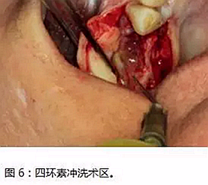 上頜竇瘺修補術(shù)——改良式旋轉(zhuǎn)帶蒂粘膜瓣修補術(shù)的應(yīng)用 上頜竇瘺修補術(shù)——改良式旋轉(zhuǎn)帶蒂粘膜瓣修補術(shù)的應(yīng)用