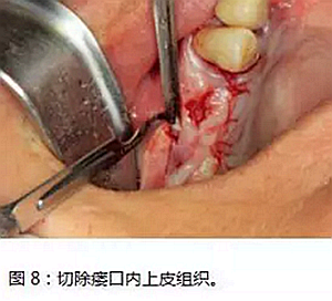 上頜竇瘺修補術(shù)——改良式旋轉(zhuǎn)帶蒂粘膜瓣修補術(shù)的應(yīng)用 上頜竇瘺修補術(shù)——改良式旋轉(zhuǎn)帶蒂粘膜瓣修補術(shù)的應(yīng)用