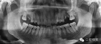 種植手術臨床與曲面斷層綜合判斷失敗病例的思與考 種植手術臨床與曲面斷層綜合判斷失敗病例的思與考