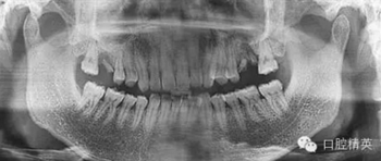 種植手術臨床與曲面斷層綜合判斷失敗病例的思與考 種植手術臨床與曲面斷層綜合判斷失敗病例的思與考