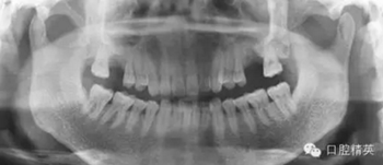 種植手術臨床與曲面斷層綜合判斷失敗病例的思與考 種植手術臨床與曲面斷層綜合判斷失敗病例的思與考
