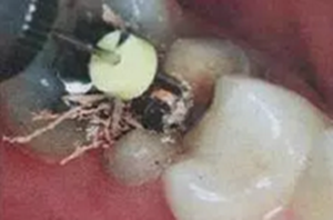 纖維樁修復(fù)之精細(xì)操作 纖維樁修復(fù)之精細(xì)操作