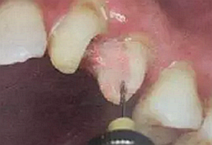 纖維樁修復(fù)之精細(xì)操作 纖維樁修復(fù)之精細(xì)操作