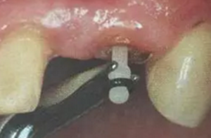 纖維樁修復(fù)之精細(xì)操作 纖維樁修復(fù)之精細(xì)操作