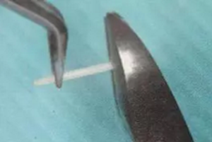 纖維樁修復(fù)之精細(xì)操作 纖維樁修復(fù)之精細(xì)操作