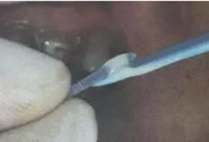 纖維樁修復(fù)之精細(xì)操作 纖維樁修復(fù)之精細(xì)操作