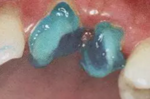 纖維樁修復(fù)之精細(xì)操作 纖維樁修復(fù)之精細(xì)操作