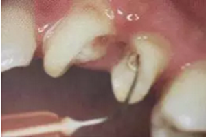 纖維樁修復(fù)之精細(xì)操作 纖維樁修復(fù)之精細(xì)操作