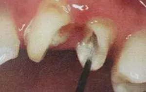 纖維樁修復(fù)之精細(xì)操作 纖維樁修復(fù)之精細(xì)操作