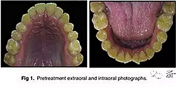 文獻(xiàn)優(yōu)秀正畸病例賞析-通過微種植釘及多曲方絲技術(shù)壓低下頜磨牙非手術(shù)矯治嚴(yán)重前牙開合患者1例 文獻(xiàn)優(yōu)秀正畸病例賞析-通過微種植釘及多曲方絲技術(shù)壓低下頜磨牙非手術(shù)矯治嚴(yán)重前牙開合患者1例
