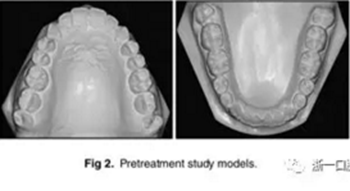 文獻(xiàn)優(yōu)秀正畸病例賞析-通過微種植釘及多曲方絲技術(shù)壓低下頜磨牙非手術(shù)矯治嚴(yán)重前牙開合患者1例 文獻(xiàn)優(yōu)秀正畸病例賞析-通過微種植釘及多曲方絲技術(shù)壓低下頜磨牙非手術(shù)矯治嚴(yán)重前牙開合患者1例