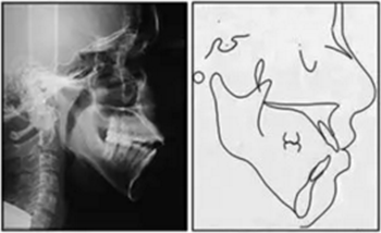 文獻(xiàn)優(yōu)秀正畸病例賞析-通過微種植釘及多曲方絲技術(shù)壓低下頜磨牙非手術(shù)矯治嚴(yán)重前牙開合患者1例 文獻(xiàn)優(yōu)秀正畸病例賞析-通過微種植釘及多曲方絲技術(shù)壓低下頜磨牙非手術(shù)矯治嚴(yán)重前牙開合患者1例