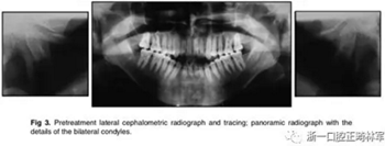 文獻(xiàn)優(yōu)秀正畸病例賞析-通過微種植釘及多曲方絲技術(shù)壓低下頜磨牙非手術(shù)矯治嚴(yán)重前牙開合患者1例 文獻(xiàn)優(yōu)秀正畸病例賞析-通過微種植釘及多曲方絲技術(shù)壓低下頜磨牙非手術(shù)矯治嚴(yán)重前牙開合患者1例