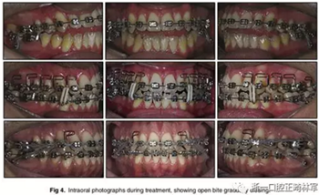 文獻(xiàn)優(yōu)秀正畸病例賞析-通過微種植釘及多曲方絲技術(shù)壓低下頜磨牙非手術(shù)矯治嚴(yán)重前牙開合患者1例 文獻(xiàn)優(yōu)秀正畸病例賞析-通過微種植釘及多曲方絲技術(shù)壓低下頜磨牙非手術(shù)矯治嚴(yán)重前牙開合患者1例