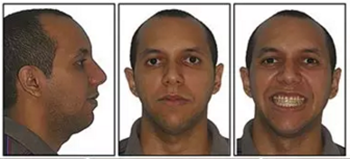 文獻(xiàn)優(yōu)秀正畸病例賞析-通過微種植釘及多曲方絲技術(shù)壓低下頜磨牙非手術(shù)矯治嚴(yán)重前牙開合患者1例 文獻(xiàn)優(yōu)秀正畸病例賞析-通過微種植釘及多曲方絲技術(shù)壓低下頜磨牙非手術(shù)矯治嚴(yán)重前牙開合患者1例