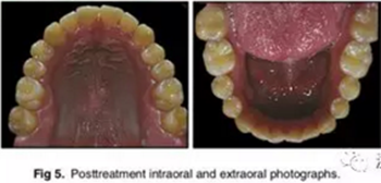 文獻(xiàn)優(yōu)秀正畸病例賞析-通過微種植釘及多曲方絲技術(shù)壓低下頜磨牙非手術(shù)矯治嚴(yán)重前牙開合患者1例 文獻(xiàn)優(yōu)秀正畸病例賞析-通過微種植釘及多曲方絲技術(shù)壓低下頜磨牙非手術(shù)矯治嚴(yán)重前牙開合患者1例