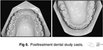 文獻(xiàn)優(yōu)秀正畸病例賞析-通過微種植釘及多曲方絲技術(shù)壓低下頜磨牙非手術(shù)矯治嚴(yán)重前牙開合患者1例 文獻(xiàn)優(yōu)秀正畸病例賞析-通過微種植釘及多曲方絲技術(shù)壓低下頜磨牙非手術(shù)矯治嚴(yán)重前牙開合患者1例