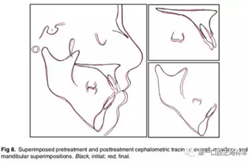 文獻(xiàn)優(yōu)秀正畸病例賞析-通過微種植釘及多曲方絲技術(shù)壓低下頜磨牙非手術(shù)矯治嚴(yán)重前牙開合患者1例 文獻(xiàn)優(yōu)秀正畸病例賞析-通過微種植釘及多曲方絲技術(shù)壓低下頜磨牙非手術(shù)矯治嚴(yán)重前牙開合患者1例