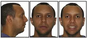 文獻(xiàn)優(yōu)秀正畸病例賞析-通過微種植釘及多曲方絲技術(shù)壓低下頜磨牙非手術(shù)矯治嚴(yán)重前牙開合患者1例 文獻(xiàn)優(yōu)秀正畸病例賞析-通過微種植釘及多曲方絲技術(shù)壓低下頜磨牙非手術(shù)矯治嚴(yán)重前牙開合患者1例