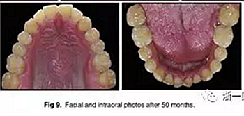 文獻(xiàn)優(yōu)秀正畸病例賞析-通過微種植釘及多曲方絲技術(shù)壓低下頜磨牙非手術(shù)矯治嚴(yán)重前牙開合患者1例 文獻(xiàn)優(yōu)秀正畸病例賞析-通過微種植釘及多曲方絲技術(shù)壓低下頜磨牙非手術(shù)矯治嚴(yán)重前牙開合患者1例