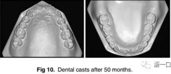 文獻(xiàn)優(yōu)秀正畸病例賞析-通過微種植釘及多曲方絲技術(shù)壓低下頜磨牙非手術(shù)矯治嚴(yán)重前牙開合患者1例 文獻(xiàn)優(yōu)秀正畸病例賞析-通過微種植釘及多曲方絲技術(shù)壓低下頜磨牙非手術(shù)矯治嚴(yán)重前牙開合患者1例