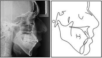 文獻(xiàn)優(yōu)秀正畸病例賞析-通過微種植釘及多曲方絲技術(shù)壓低下頜磨牙非手術(shù)矯治嚴(yán)重前牙開合患者1例 文獻(xiàn)優(yōu)秀正畸病例賞析-通過微種植釘及多曲方絲技術(shù)壓低下頜磨牙非手術(shù)矯治嚴(yán)重前牙開合患者1例