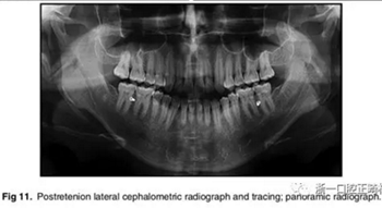 文獻(xiàn)優(yōu)秀正畸病例賞析-通過微種植釘及多曲方絲技術(shù)壓低下頜磨牙非手術(shù)矯治嚴(yán)重前牙開合患者1例 文獻(xiàn)優(yōu)秀正畸病例賞析-通過微種植釘及多曲方絲技術(shù)壓低下頜磨牙非手術(shù)矯治嚴(yán)重前牙開合患者1例
