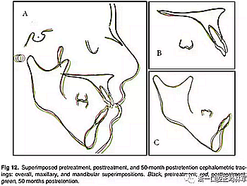 文獻(xiàn)優(yōu)秀正畸病例賞析-通過微種植釘及多曲方絲技術(shù)壓低下頜磨牙非手術(shù)矯治嚴(yán)重前牙開合患者1例 文獻(xiàn)優(yōu)秀正畸病例賞析-通過微種植釘及多曲方絲技術(shù)壓低下頜磨牙非手術(shù)矯治嚴(yán)重前牙開合患者1例