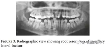 文獻優(yōu)秀正畸病例賞析--上頜中切牙區(qū)受傷后自體牙移植及正畸治療13年隨訪病例 文獻優(yōu)秀正畸病例賞析--上頜中切牙區(qū)受傷后自體牙移植及正畸治療13年隨訪病例