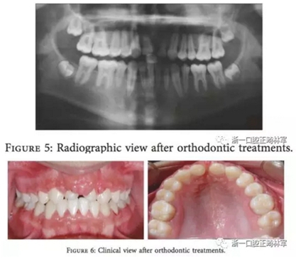 文獻優(yōu)秀正畸病例賞析--上頜中切牙區(qū)受傷后自體牙移植及正畸治療13年隨訪病例 文獻優(yōu)秀正畸病例賞析--上頜中切牙區(qū)受傷后自體牙移植及正畸治療13年隨訪病例