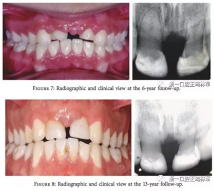 文獻優(yōu)秀正畸病例賞析--上頜中切牙區(qū)受傷后自體牙移植及正畸治療13年隨訪病例 文獻優(yōu)秀正畸病例賞析--上頜中切牙區(qū)受傷后自體牙移植及正畸治療13年隨訪病例