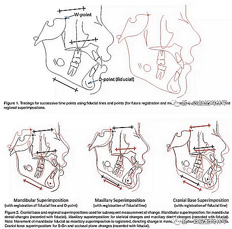 正畸文獻閱讀--不同頸椎成熟狀態(tài)使用Forsus矯治器治療II類患者的矯治效果比較 正畸文獻閱讀--不同頸椎成熟狀態(tài)使用Forsus矯治器治療II類患者的矯治效果比較
