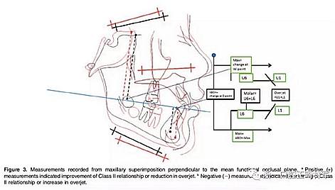 正畸文獻閱讀--不同頸椎成熟狀態(tài)使用Forsus矯治器治療II類患者的矯治效果比較 正畸文獻閱讀--不同頸椎成熟狀態(tài)使用Forsus矯治器治療II類患者的矯治效果比較