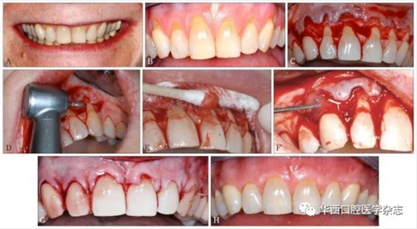 2016口腔醫(yī)師資格考試-口組-牙周膜 2016口腔醫(yī)師資格考試-口組-牙周膜